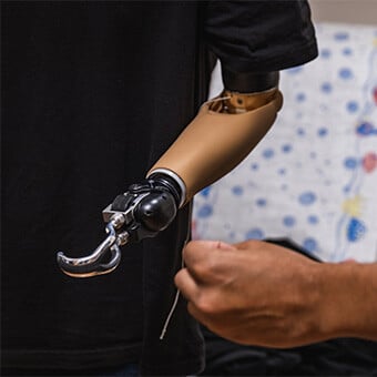 Building Confidence with a Prosthetic