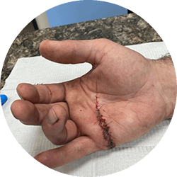 lacerations of the nerve and tendon
