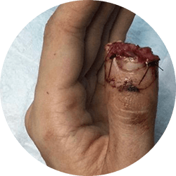 wound care